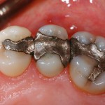 Silver fillings have become a health concern because they leach mercury into the body. 